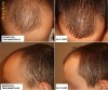 Opreste caderea parului (chelie, calvitie, alopecie) Kirkland Minoxidil 5%